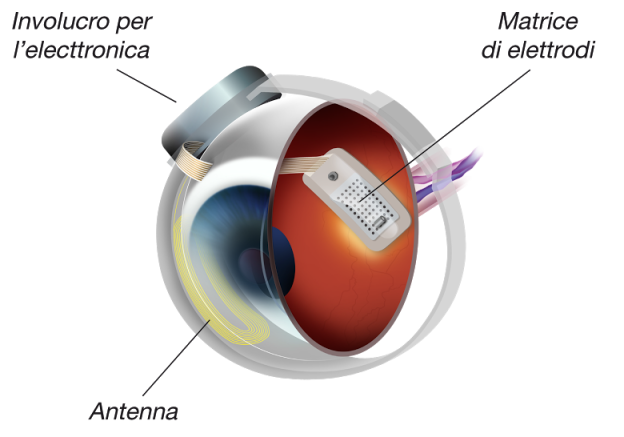 Primo impianto al mondo di occhio bionico su paziente affetto degenerazione maculare senile secca