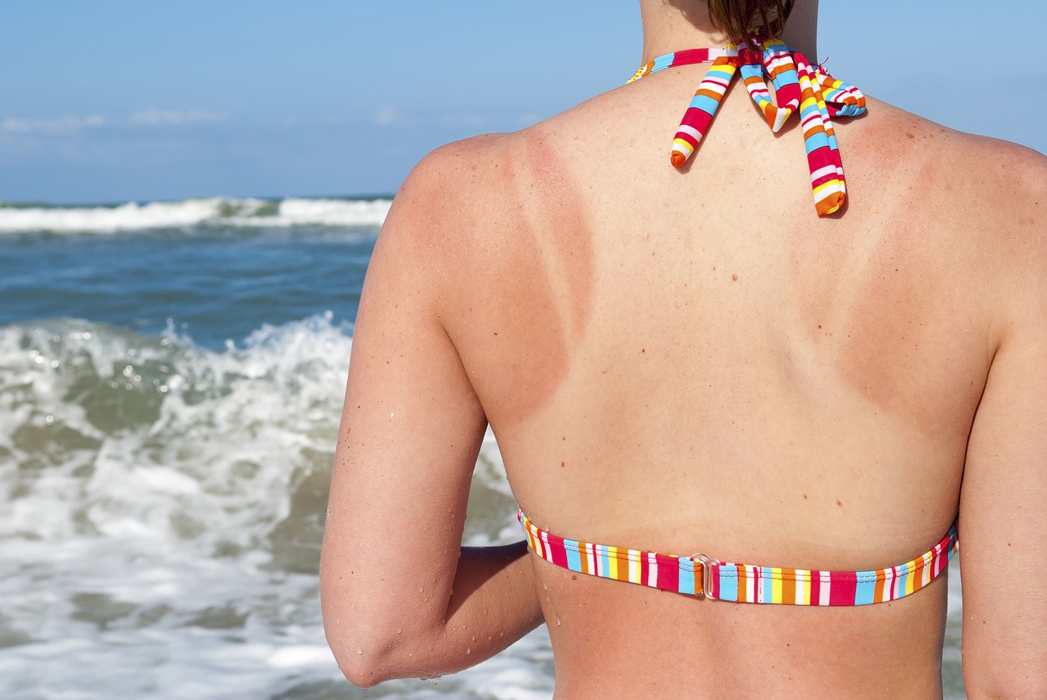 Troppo sole e scottature per un bambino italiano su 4: “Il Sole per amico” rilancia la prevenzione del melanoma