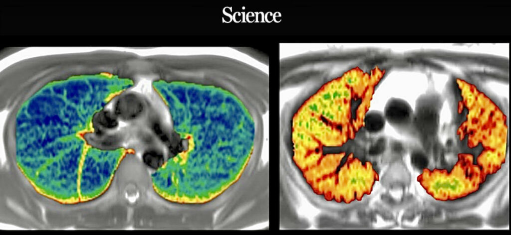 Una scansione polmonare eseguita diversi mesi dopo l’infezione da un paziente ricoverato in ospedale con COVID-19 (a destra) mostra più segni di cambiamenti infiammatori (rossi e gialli) rispetto a una scansione di una persona non infetta (a sinistra). GRUPPO COLLABORATIVO C-MORE PHOSP-COVID 